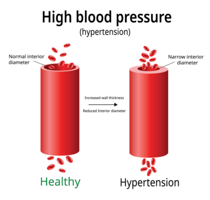 Best Hypertension Medication for Elderly