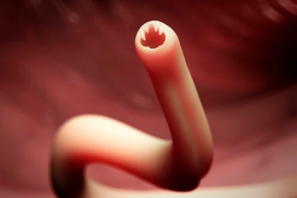 Hookworm Infections