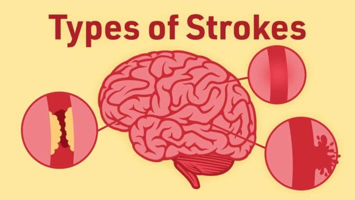 Everything You Need to Know About Stroke