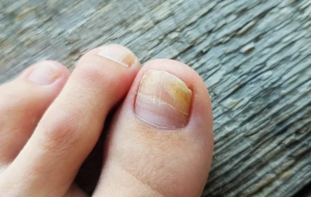 Fungal Nail Infection
