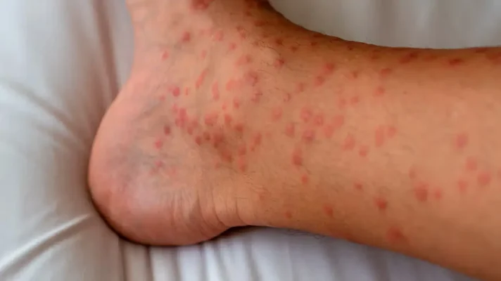 skin rashes