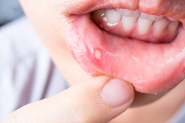 How to Cure Mouth Ulcers Fast Naturally