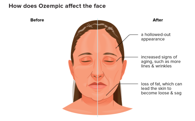 Ozempic face