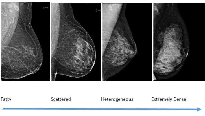 Women Will Be Notified of Breast Density After a Mammogram: What to Know